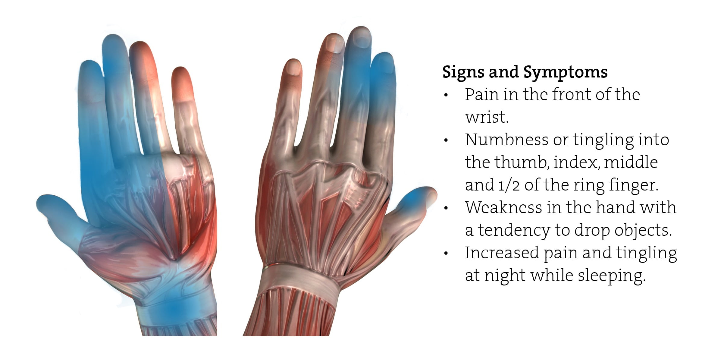 Carpal Tunnel Syndrome CTS In The Workplace Healthscreen UK